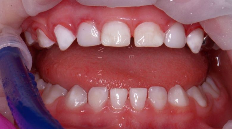 Лучшие стоматология для детей. Лечение зубов в седации для детей - фото после процедуры