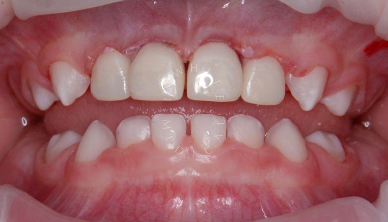 Лучшие стоматология для детей. Лечение под наркозом - профессиональная гигиена и установка 4 керамических коронок - фото после процедуры