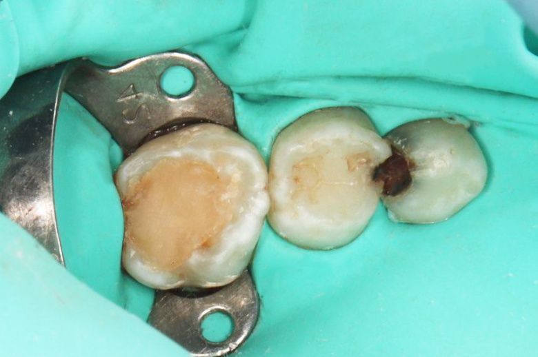  - photo before the procedure
