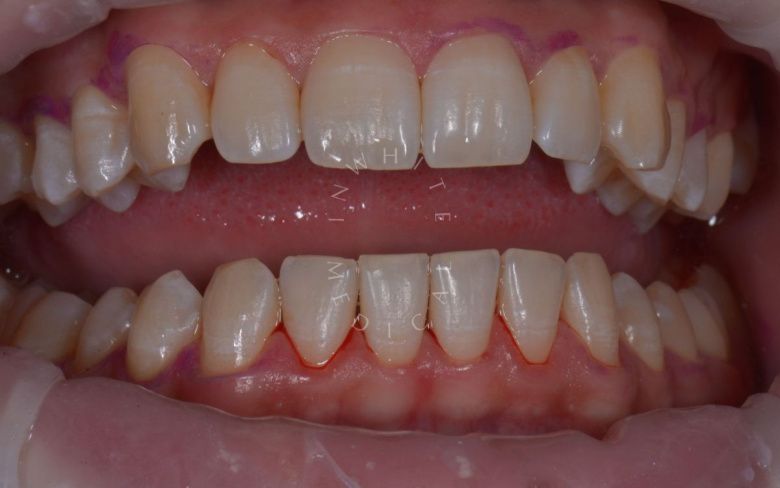  - photo after the procedure