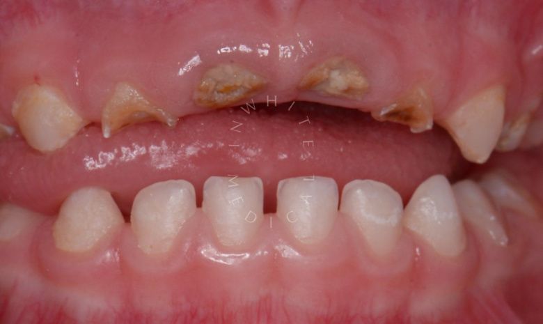 Лучшие детские стоматологии. Лечение зубов в наркозе у детей - фото до процедуры