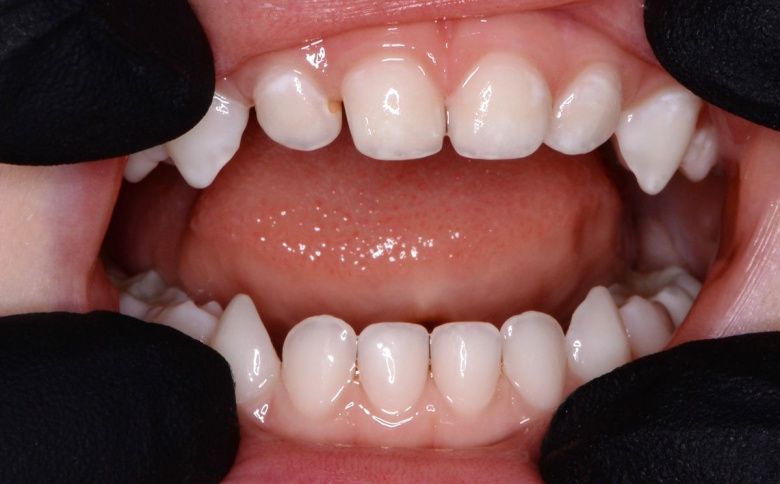  - photo after the procedure