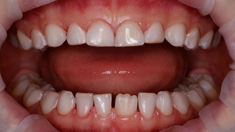  - photo after the procedure