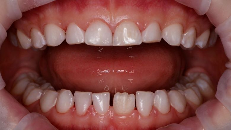 Лучшие стоматология для детей. Гигиена зубов в сменном прикусе - фото после процедуры