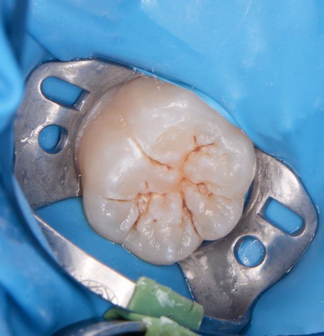  - photo before the procedure