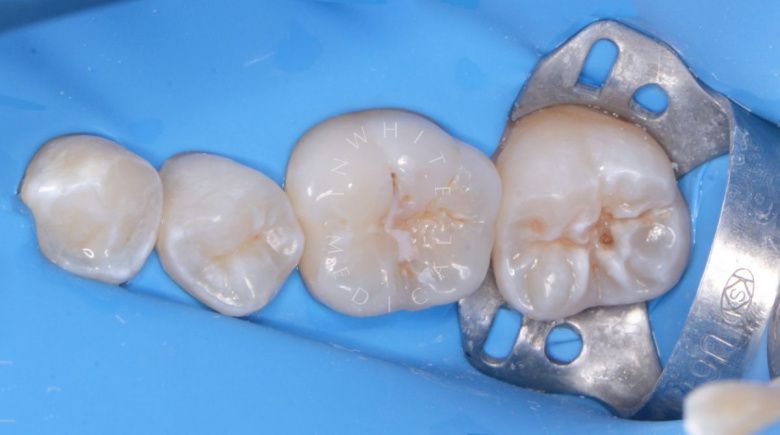 Фото до Лечение кариеса постоянных зубов у детей в клинике Inwhite Medical