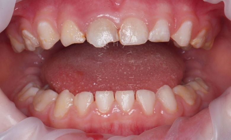 Лучшие стоматология для детей. Лечение во сне - установка коронок, удаление зубов и проведение профессиональной гигиены - фото до процедуры