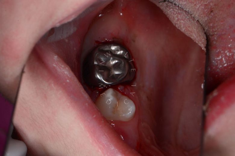  - photo after the procedure