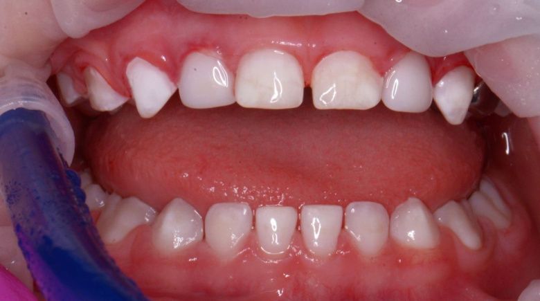  - photo after the procedure