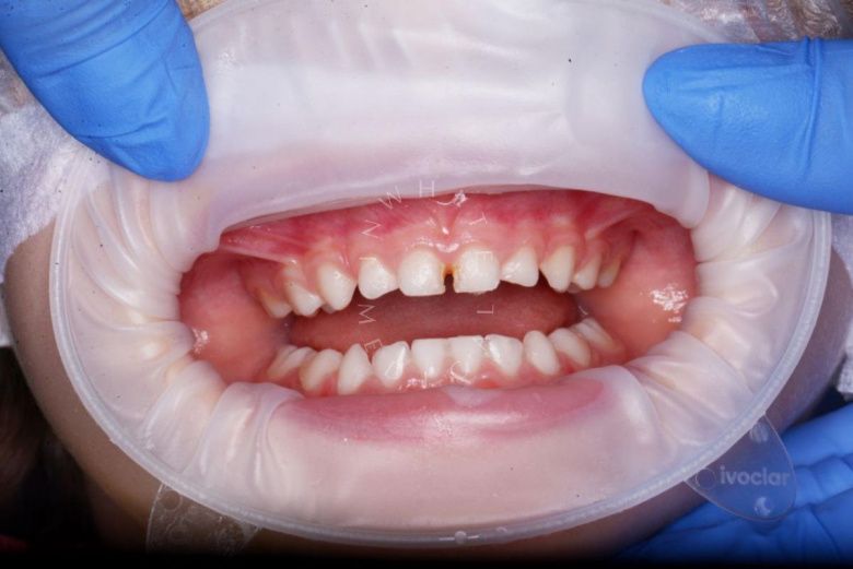 Лучшие стоматология для детей. Лечение детей под наркозом - фото до процедуры