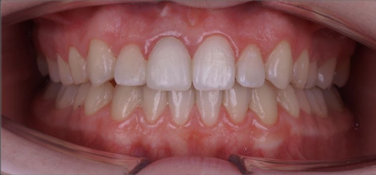  - photo after the procedure