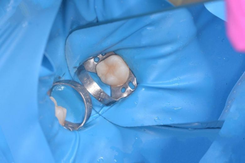  - photo after the procedure