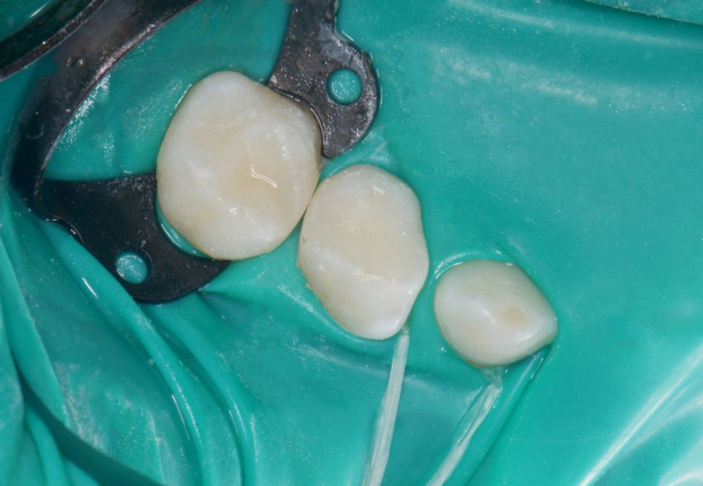 Самые лучшие детские стоматологи. Лечение кариеса у детей за один визит - photo after the procedure