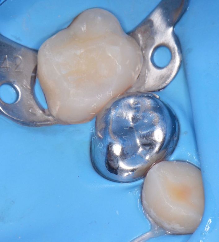 Лучшие стоматология для детей. Лечение контактного кариеса у детей - фото после процедуры