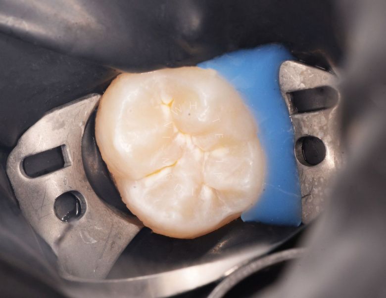  - фото после процедуры