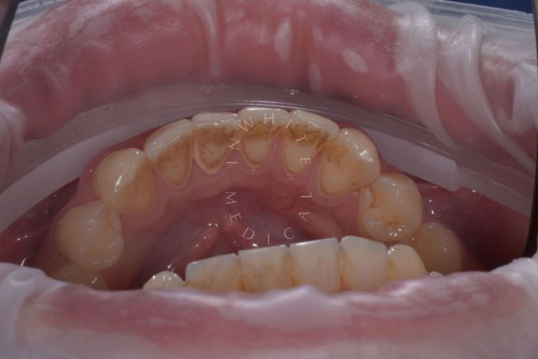  - photo before the procedure