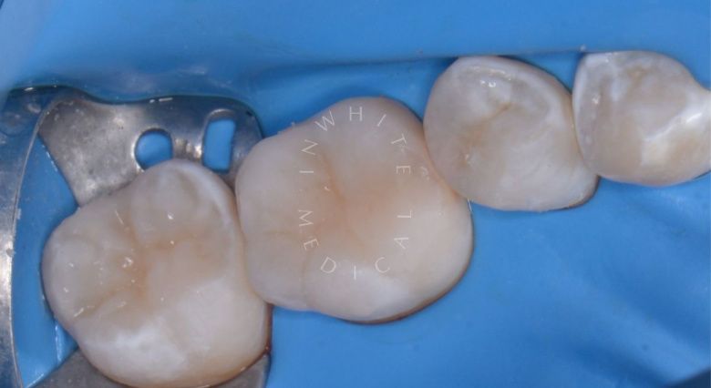 Лучшие стоматологии детские платные. Лечение кариеса у детей - фото после процедуры