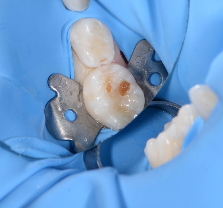 Фото до Лечение кариеса жевательных зубов у детей в клинике Inwhite Medical