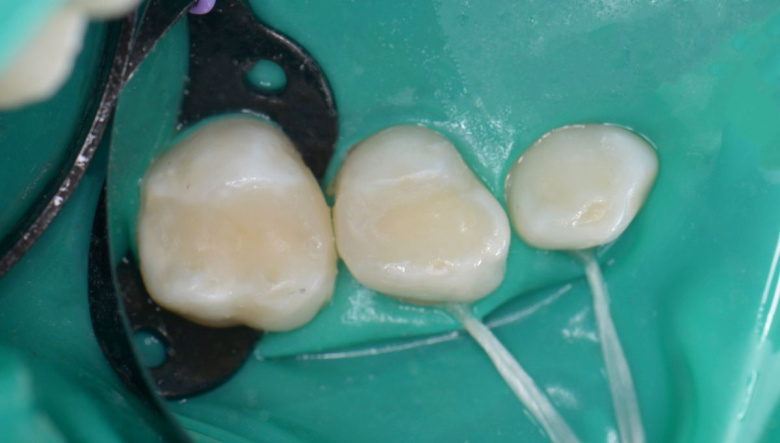  - photo after the procedure