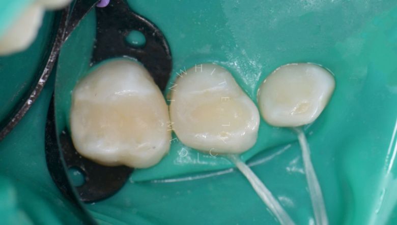 Самые лучшие детские стоматологи. Лечение контактного кариеса зубов - фото после процедуры