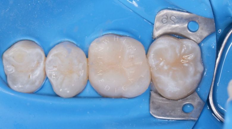 Фото после Лечение кариеса постоянных зубов у детей в клинике Inwhite Medical