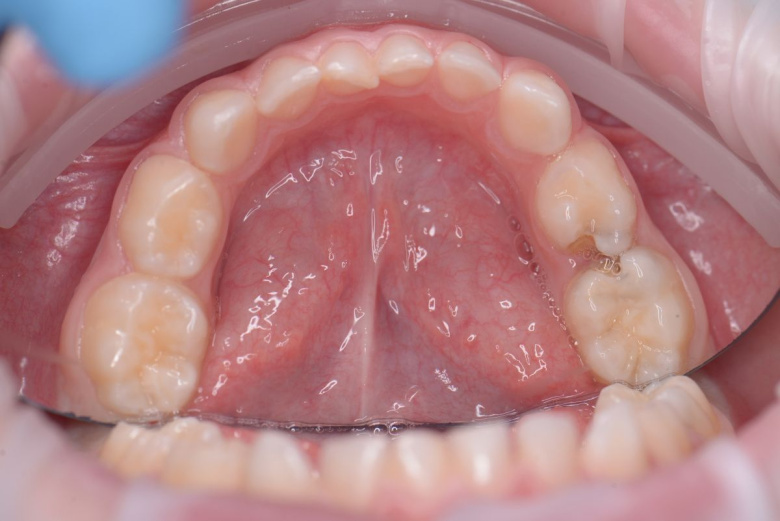  - photo before the procedure