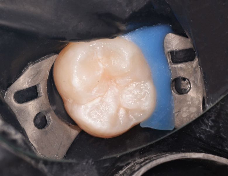  - фото до процедуры