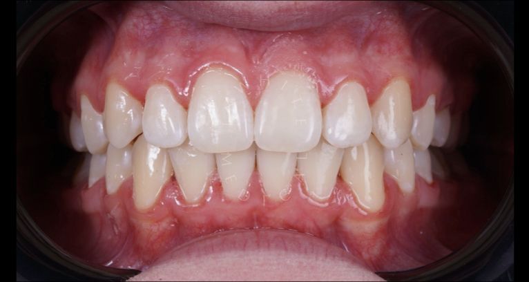  - photo after the procedure