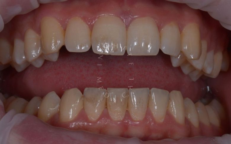  - photo before the procedure