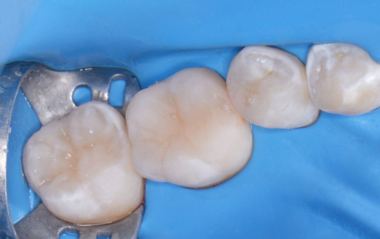  - photo after the procedure
