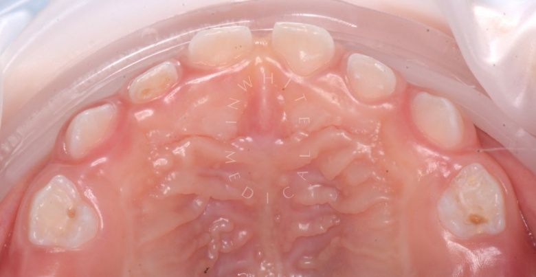 Лучшие стоматология для детей. Лечение детей в наркозе - установка металлических коронок - фото до процедуры