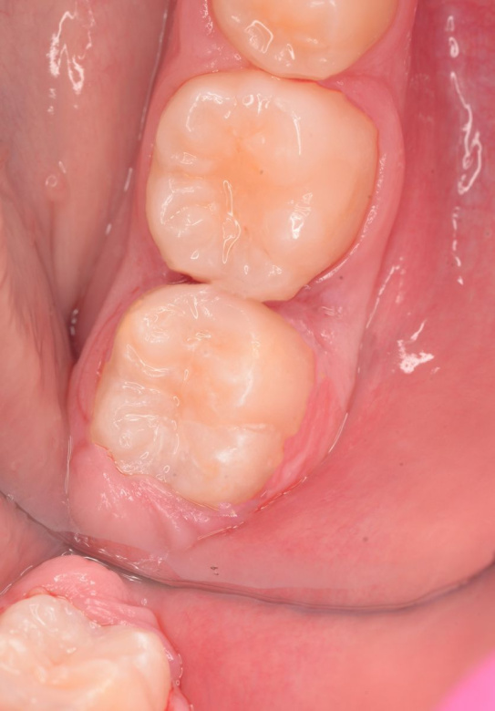  - photo after the procedure