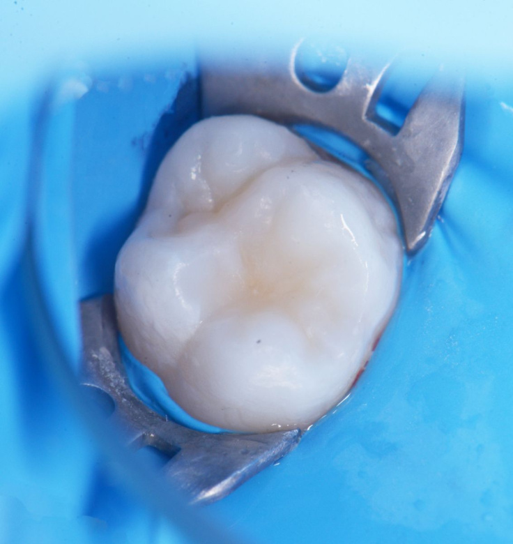  - photo after the procedure