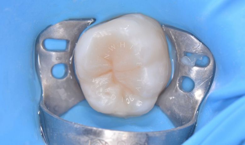 Детская стоматология Раменки. Лечение кариеса с восстановлением анатомии зуба у детей - фото после процедуры