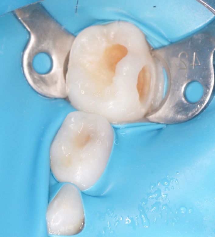 Лучшие стоматология для детей. Лечение множественного кариеса у детей - фото до процедуры