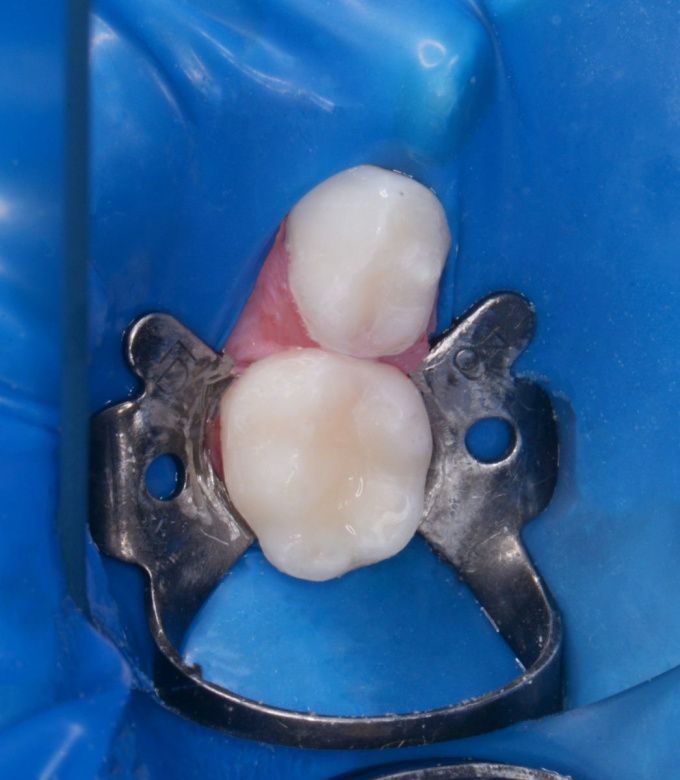  - photo after the procedure