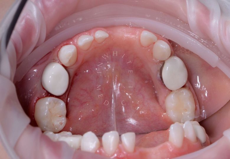  - photo after the procedure