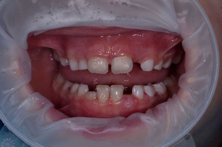  - photo after the procedure