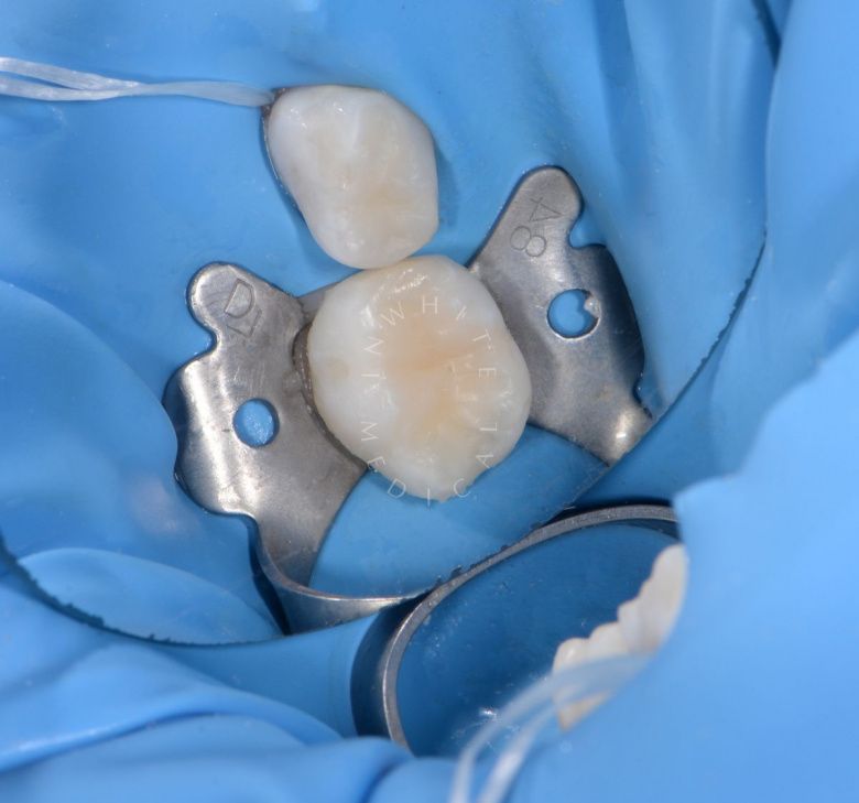 Фото после Лечение кариеса жевательных зубов у детей в клинике Inwhite Medical