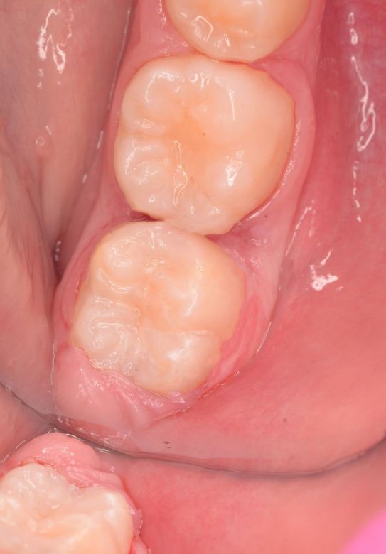  - photo after the procedure