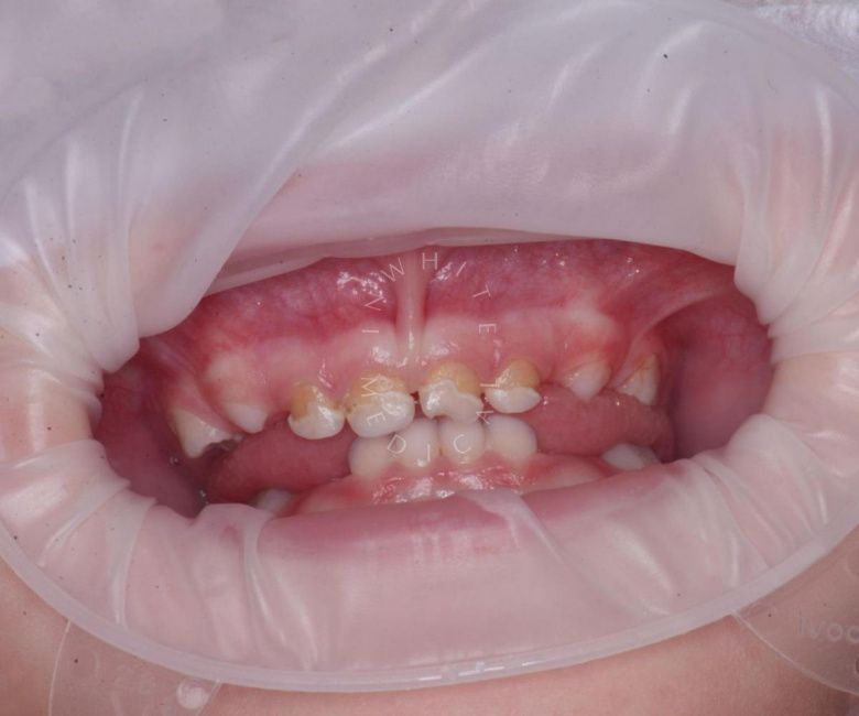 Лучшие стоматологии детские платные. Лечение молочных зубов во сне - фото до процедуры