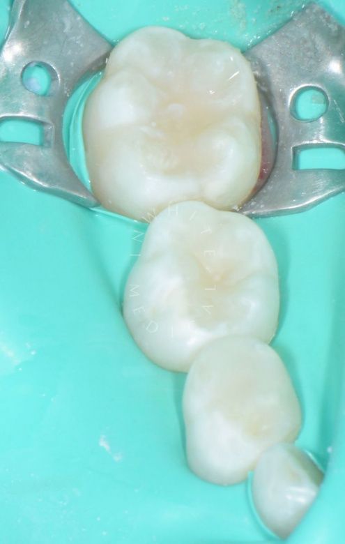 Лучшие стоматология для детей. Лечение кариесов и герметизация фиссур у детей - фото после процедуры