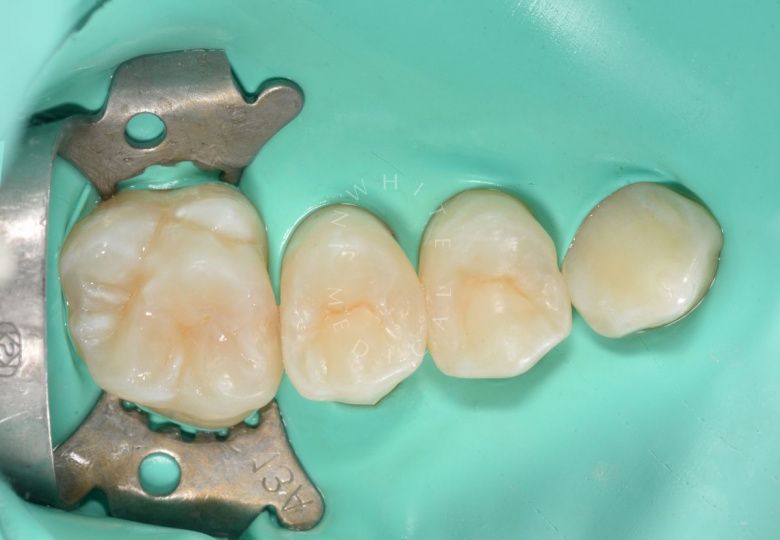 Детская стоматология Раменки. Лечение контактного кариеса 2-х зубов у детей - фото после процедуры