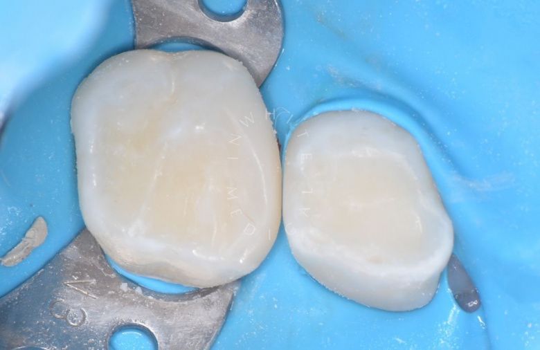 Лучшие стоматология для детей. Лечение межзубного кариеса у детей - фото после процедуры