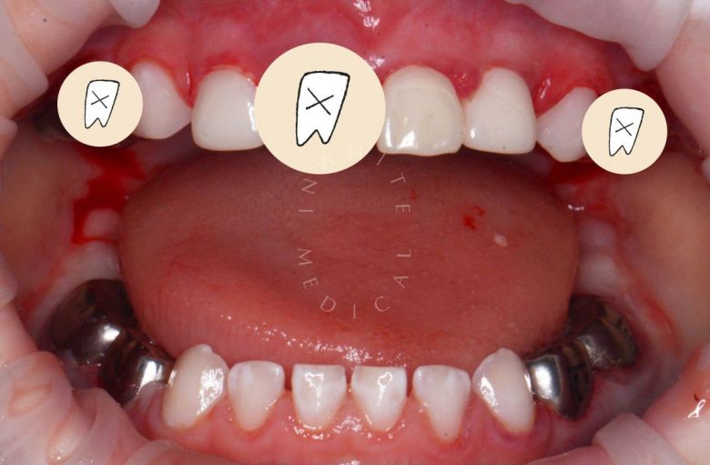 Лучшие стоматология для детей. Лечение во сне - установка коронок, удаление зубов и проведение профессиональной гигиены - фото после процедуры