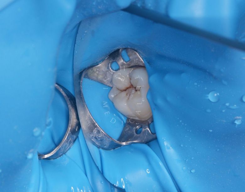 Лучшие стоматологии детские платные. Лечение кариеса постоянного зуба у детей - фото до процедуры