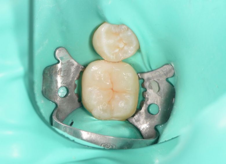 Детская стоматология Раменки. Лечение кариеса жевательного зуба детям - фото после процедуры