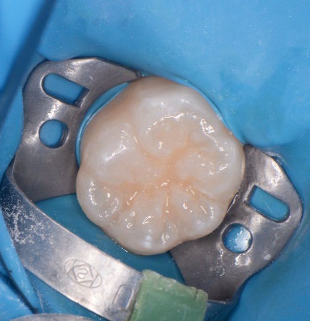  - photo after the procedure