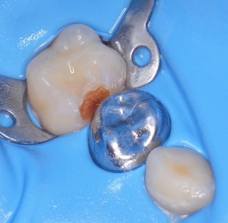 Лучшие стоматология для детей. Лечение контактного кариеса у детей - фото до процедуры