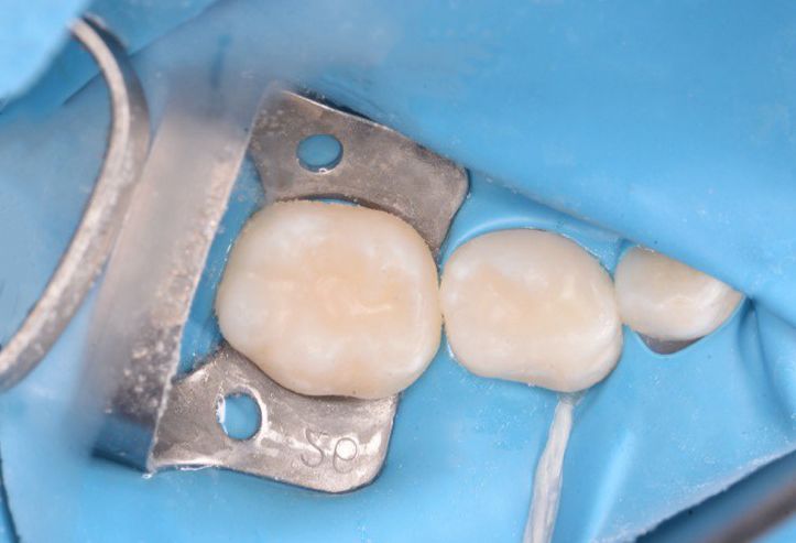  - photo after the procedure